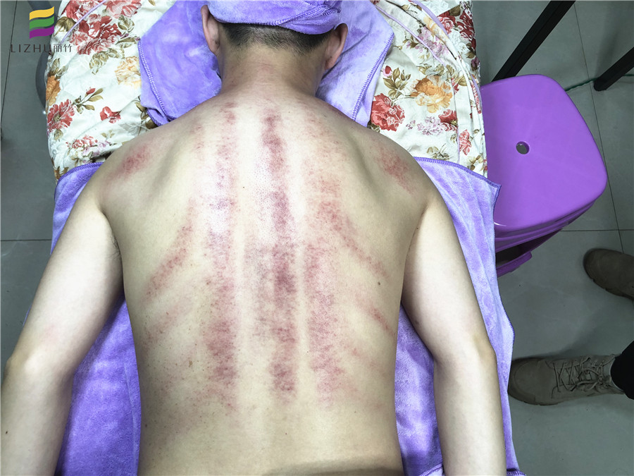 南寧美容學(xué)校：美容直播搶先看---背部刮痧