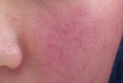 如何拯救你的敏感??？廣西南寧美容培訓(xùn)叫你正確方法