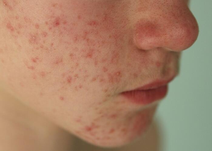 粉刺閉口應該如何處理？