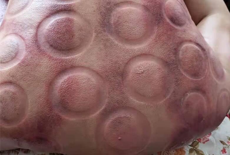 怎樣拔火罐？南寧美容學(xué)校手把手教你