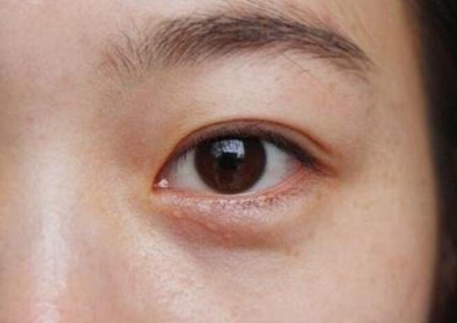 黑眼圈的種類有哪些？廣西美容培訓(xùn)教你保養(yǎng)