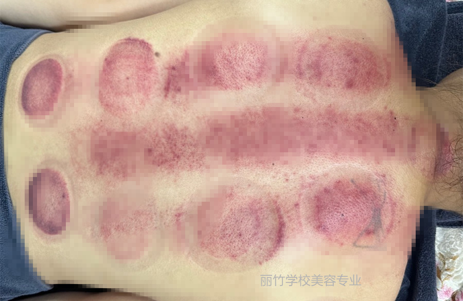 拔火罐的顏色代表什么？南寧美容美體專業(yè)實訓(xùn)